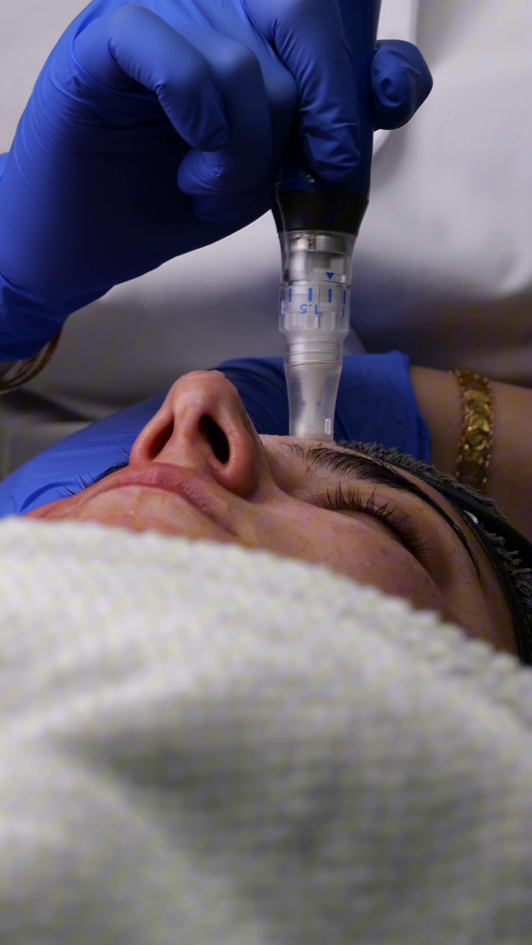 A microneedling treatment being carried out on a client's face